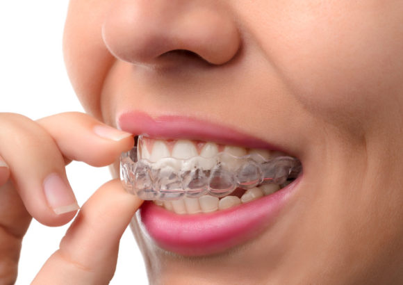 Invisalign